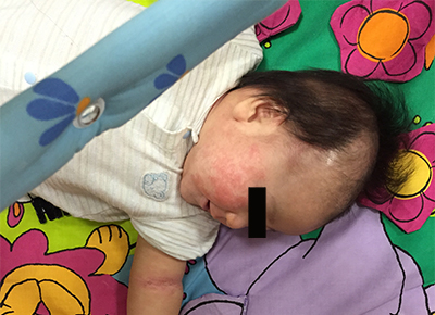 実録 赤ちゃんの肌荒れに要注意 アトピー アレルギー発症前に早く治したい6つの肌トラブル ちょこままチャンネル