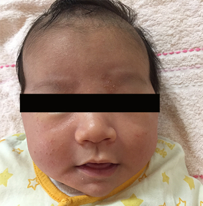 生後1か月。乳児湿疹。この後、いくつかの肌トラブルを経て、0歳7か月でアレルギー発覚する。（アレルギーブログの記録より）
