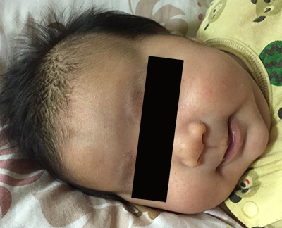 生後2か月。乳児脂漏性湿疹が現れ始める。この後、いくつかの肌トラブルを経て、0歳7か月でアレルギー発覚する。（アレルギーブログの記録より）